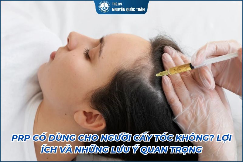 prp có dùng cho người cấy tóc không