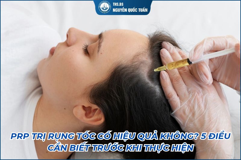 prp trị rụng tóc có hiệu quả không