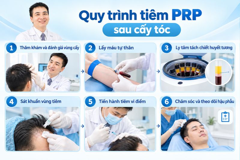  Quy trình tiêm PRP sau cấy tóc 