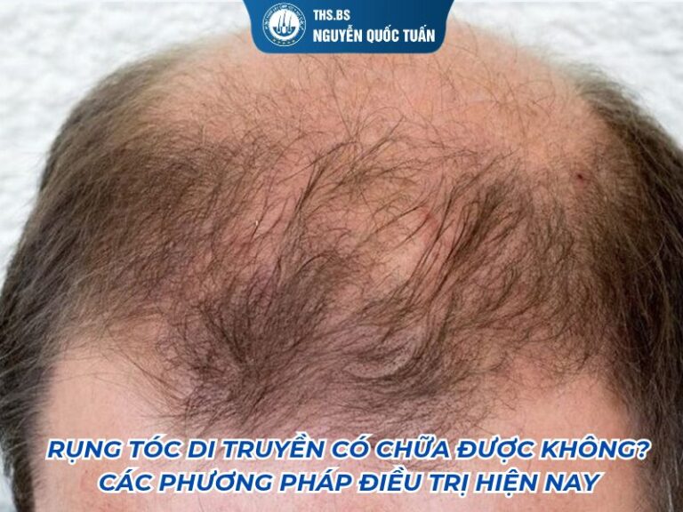 rụng tóc di truyền có chữa được khôn g