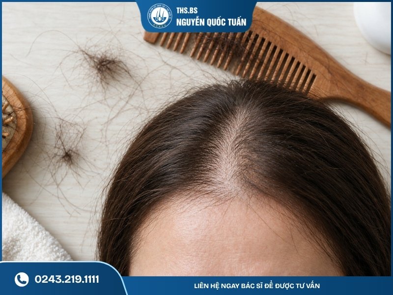 Sợ tóc tiếp tục rụng sau cấy, kết quả không duy trì lâu dài 