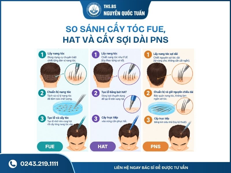So sánh cấy tóc FUE, HAT vs cấy sợi dài PNS