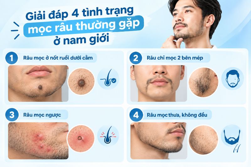 Giải đáp 4 tình trạng mọc râu thường gặp ở nam giới