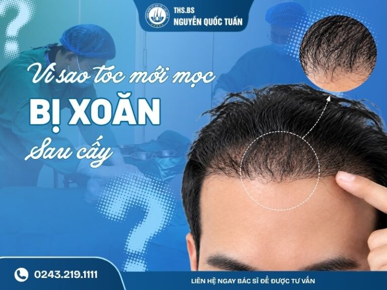 vì sao tóc mới mọc bị xoăn sau cấy