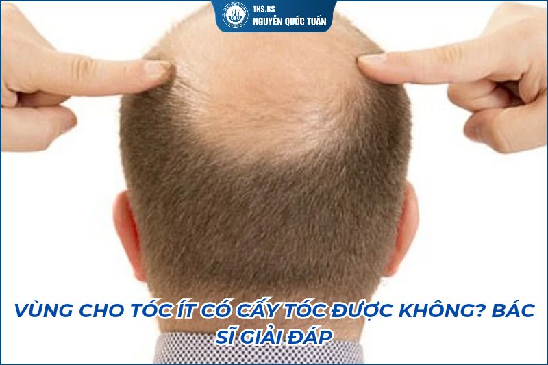 vùng cho tóc ít có cấy tóc được không